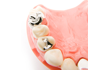 銀歯のデメリットをご存じですか？