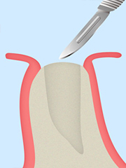 STEP01歯ぐきの切開