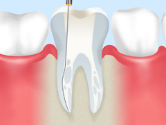 重度の虫歯は根元から治します